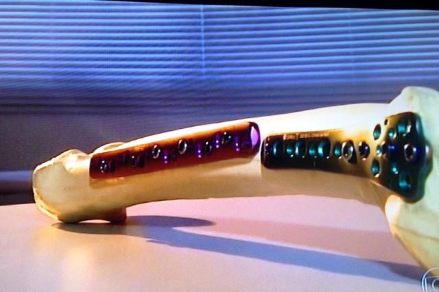 Senado terá CPIs para investigar HSBC e máfia das próteses Reprodução/RBS TV