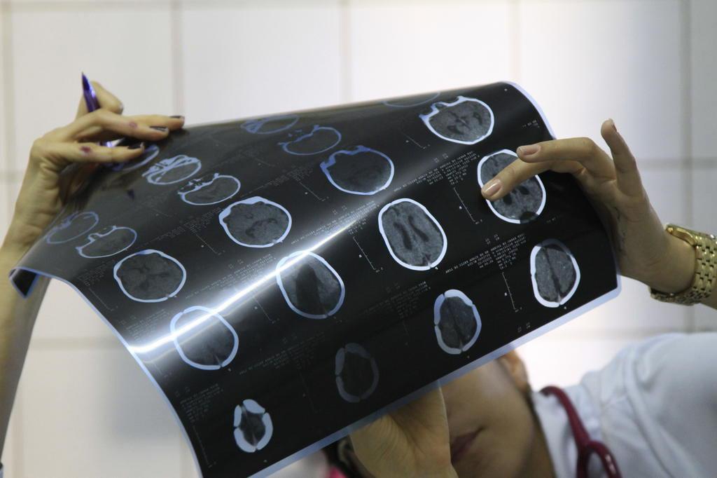 Governo muda critério para definição de casos de microcefalia