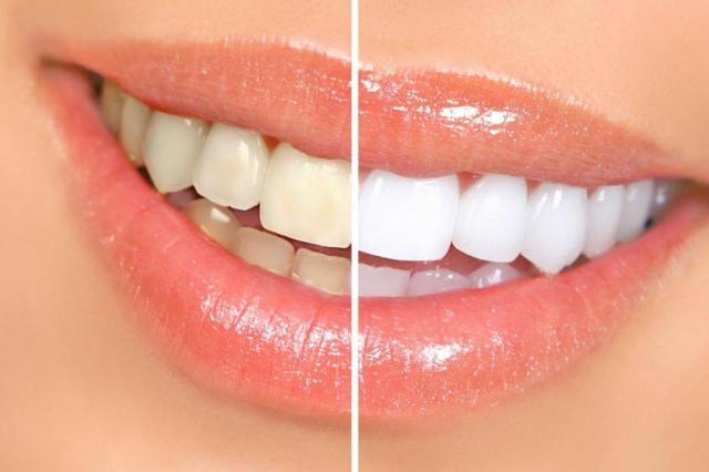 Por que os dentes ficam amarelados? UFSC/Divulgação
