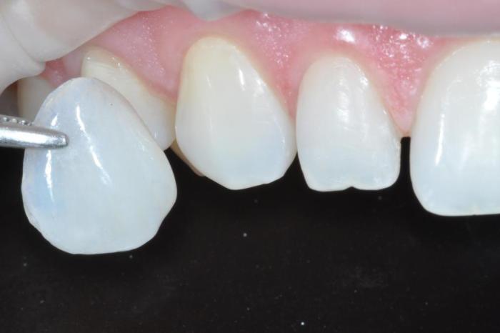 Lente de contato nos dentes? Conheça o tratamento que transforma o sorriso e ajuda na autoestima